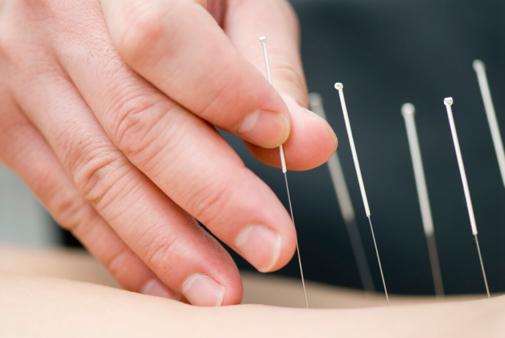 Dr. Alik performing an acupuncture treatment for arthritis