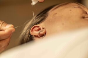 Neuroacupuncture stimulates key points on the body, including the scalp and ears.
