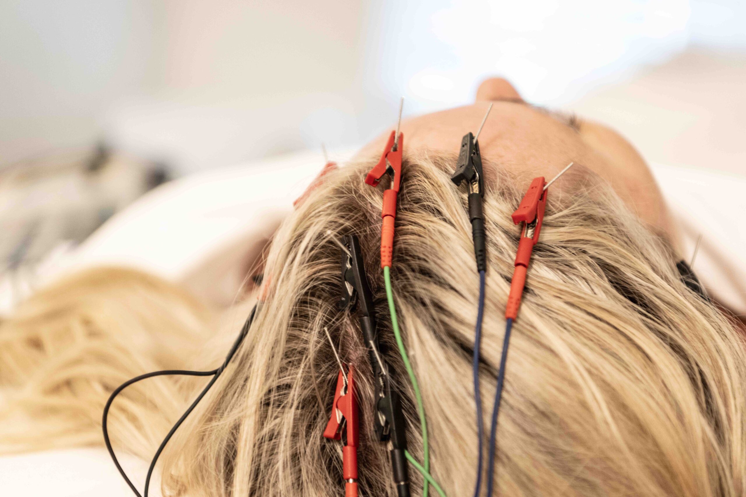 Scalp Acupuncture in Naples Florida with Dr. Alik Minikhanov